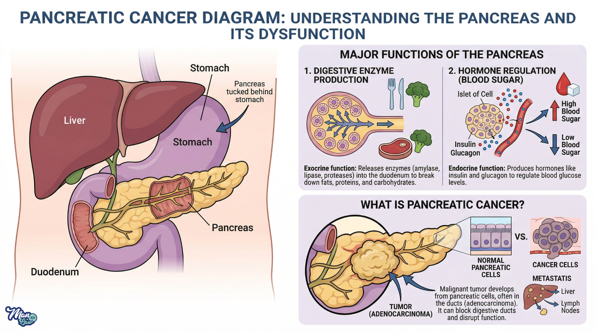 Man Law 101 PancreaticCancer Diagram Inline